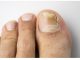 OVO JE NAJBOLJI LIJEK ZA GLJIVICE NA NOKTIMA: Pomiješajte ove sastojke i potopite prste, NESTAT ĆE PREKO NOĆI