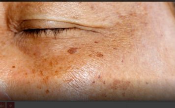 Ova smjesa briše tamne mrlje kao gumicom, zapišite recept