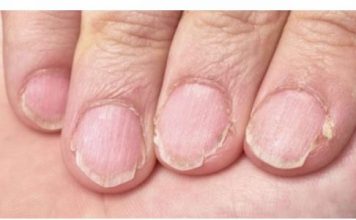 MUČE VAS UMOR, TANKA KOSA I LOMLJIVI NOKTI, EVO ŠTA VAM NEDOSTAJE U ISHRANI