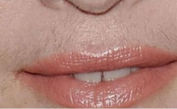 SVAKA ŽENA ZASLUŽUJE DA OVO ZNA: Prirodnim putem uklonite brkove i druge neželjene dlačice sa tijela zauvijek