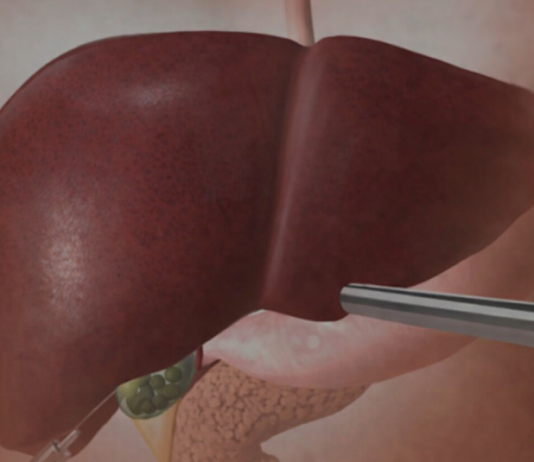 Jetra pod pritiskom: namirnice koje je opterećuju gotovo kao alkohol