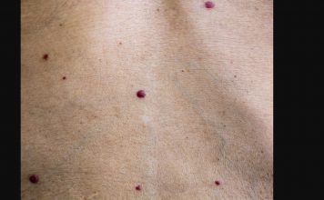IMATE LI OVE CRVENE TAČKICE NA TIJELU? To nisu popucali kapilari, EVO O ČEMU SE ZAISTA RADI