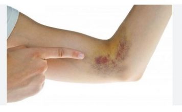 AKO OVO PRIMJETITE IDITE DOKTORU: Simptomi krvnih ugrušaka u vašem tijelu!