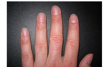 IMATE LI OVAKVE IZBOČINE NA NOKTIMA – evo šta one znače: Doktorica otkrila i možda ćete se iznenaditi