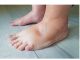 NAJVAŽNIJI vitamin za otklanjanje otoka ruku, nogu i stopala!
