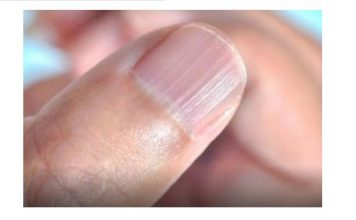 IMATE LI OVAKVE IZBOČINE NA NOKTIMA – evo šta one znače: Doktorica otkrila i možda ćete se iznenaditi