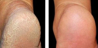 ZA MEKA STOPALA POTREBNA SU VAM SAMO 3 SASTOJKA IZ KUHINJE: Potopite noge u ovu smjesu na 15 minuta i recite zbogom ispucalim petama