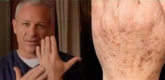 Sok od luka + jabukovo sirće: Samo pomiješajte i riješite se staračkih pjega narukama, licu i dekolteu jednom za svagda!