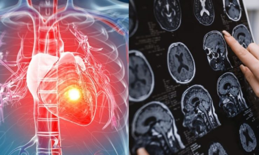 Infarkt i moždani udari mnikad ne dolaze bez upozorenja: Kardiolog tvrdi da im u 99 % slučajeva prethode ova 4 faktora rizika