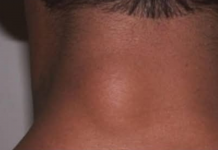 ZA MANJE OD 10 DANA: Riješite se masnog tkiva bez hiruškog odstranjivanja!