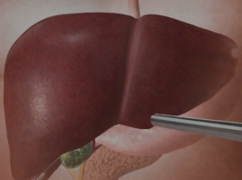 Jetra pod pritiskom: namirnice koje je opterećuju gotovo kao alkohol