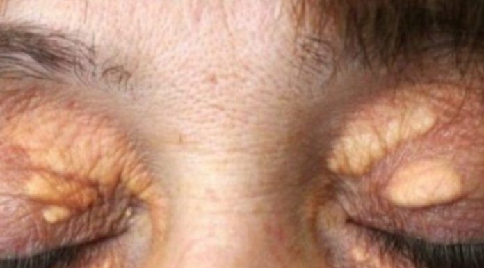 STAVILA SAM OVU NAMIRNICU NA MASNO TKIVO KOD OKA, ono je preko noći nestalo: EVO ŠTA ME SPASILO, SVI GA IMATE U KUĆI STAVILA SAM OVU NAMIRNICU NA MASNO TKIVO KOD OKA, ono je preko noći nestalo: EVO ŠTA ME SPASILO, SVI GA IMATE U KUĆI - featured image