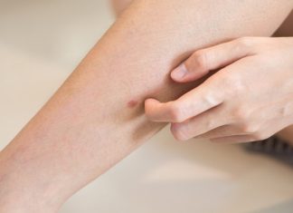 „Šta uzrokuje svrab na različitim dijelovima tijela: kada je bezopasan, a kada potražiti savjet ljekara“
