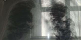 OVO JE PRVI SIMPTOM RAKA PLUĆA, A NIJE KAŠALJ: Većina ljudi ga nikad ne poveže sa ovom opakom bolešću!