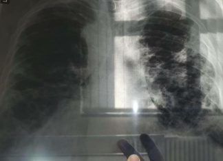 OVO JE PRVI SIMPTOM RAKA PLUĆA, A NIJE KAŠALJ: Većina ljudi ga nikad ne poveže sa ovom opakom bolešću!